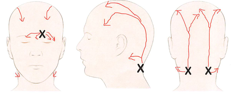 What is Migraine Surgery? | Migraine Surgery Society